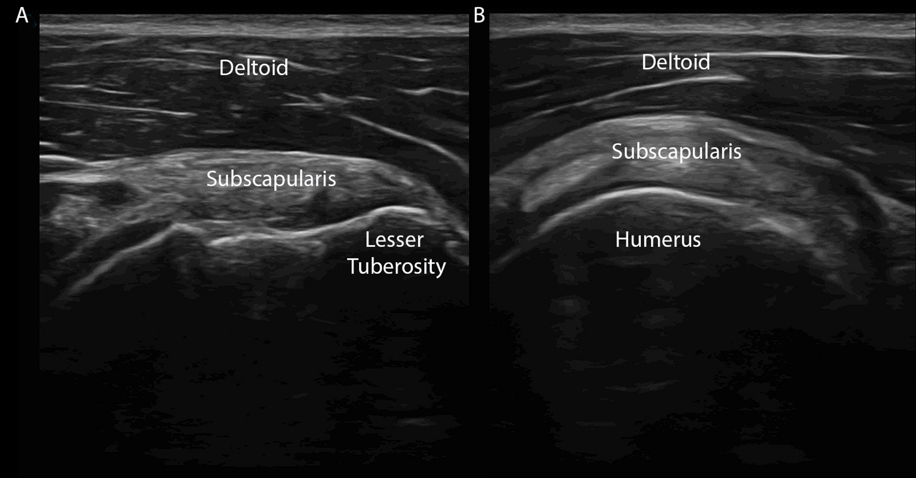 Pdf Ultrasound Of The Shoulder Joint For Impingement Syndrome The