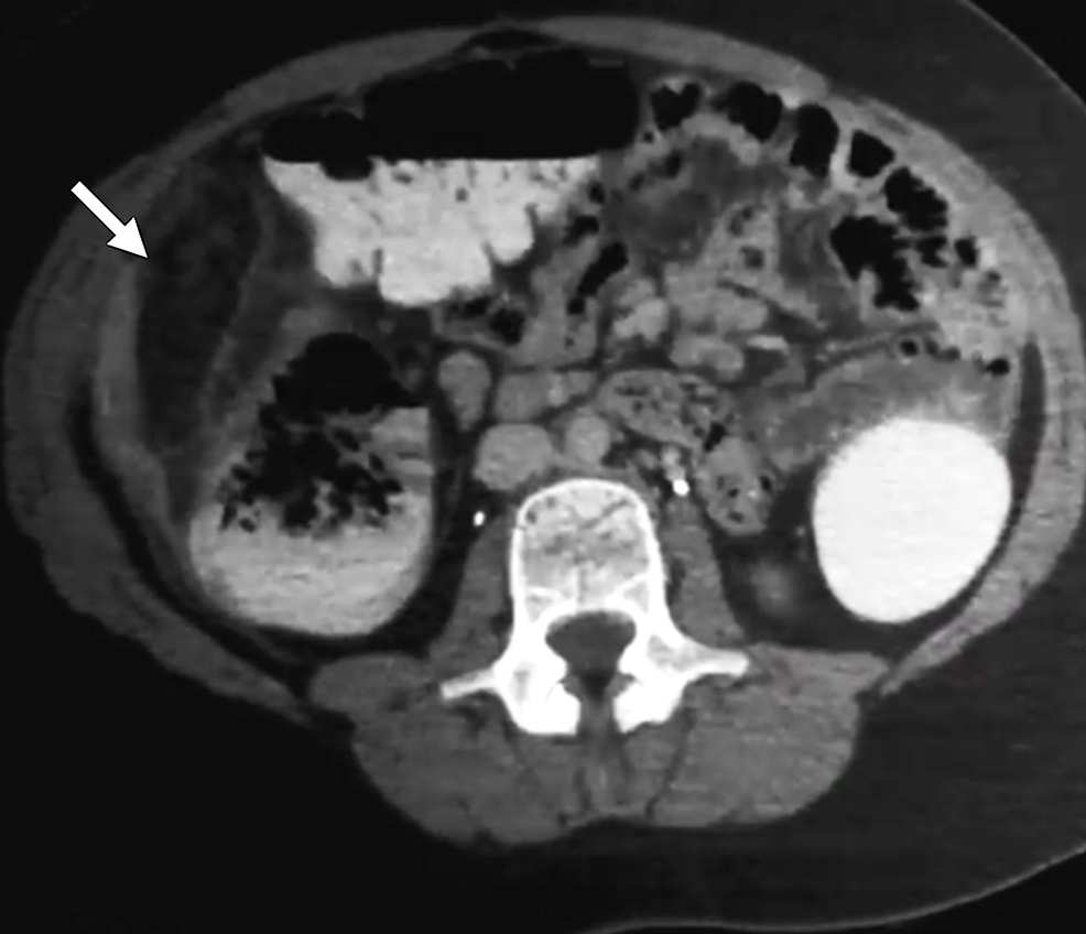 Acute Omental Infarction Mimicking Acute Appendicitis Cureus