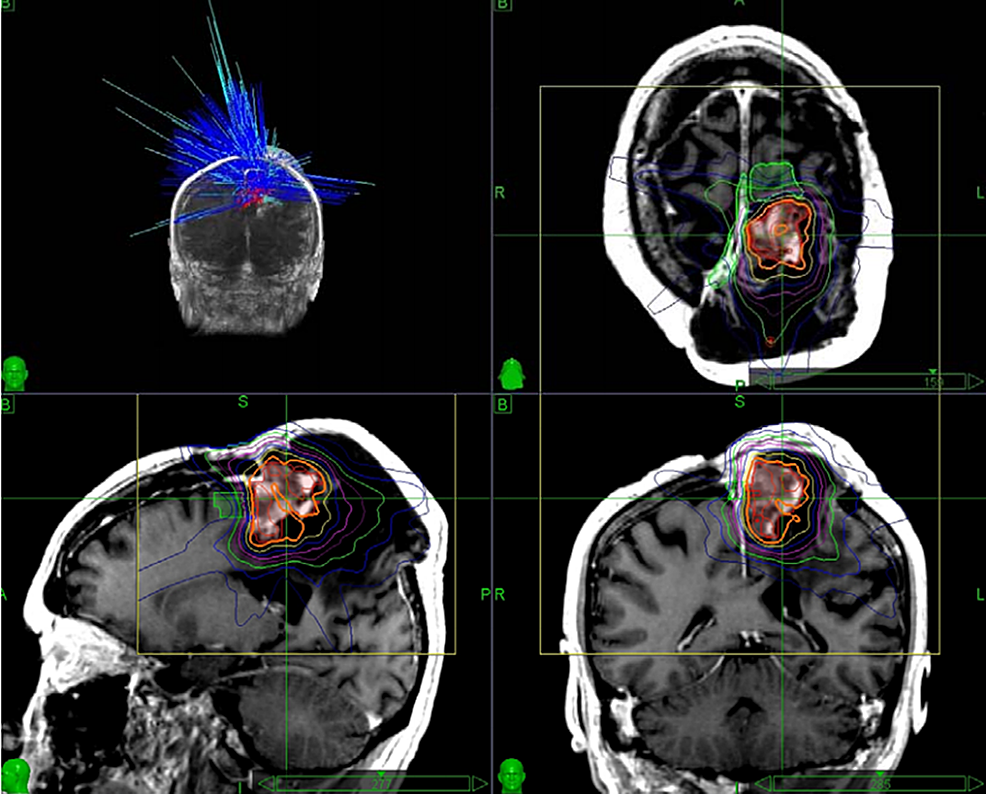 Stereotactic Radiosurgery In The Treatment Of Glioblastoma Multiforme