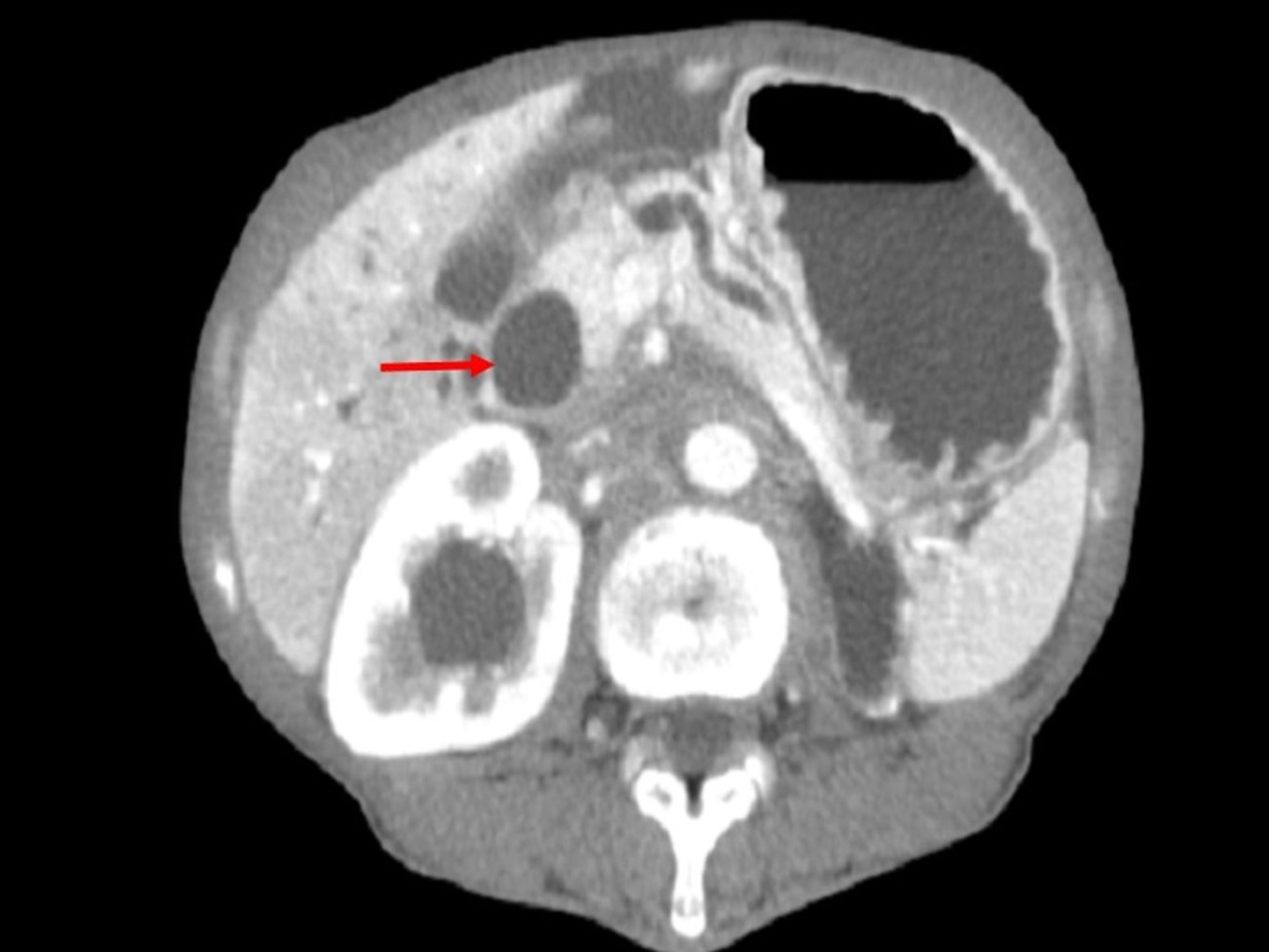 Cureus Severe Symptomatic Hypochloremia Associated With Rare Signet Ring Cell Carcinoma Of The