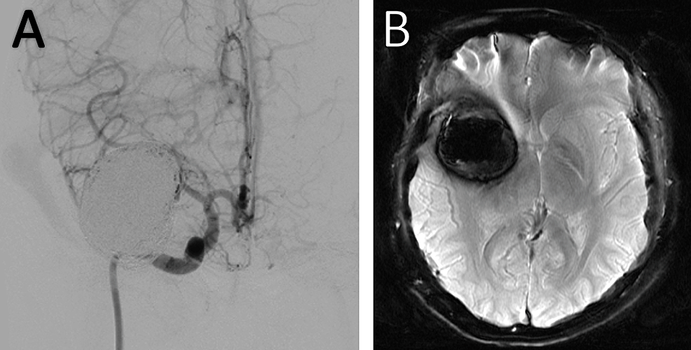 Cureus Stentassisted Embolization of a Giant Aneurysm of the Middle