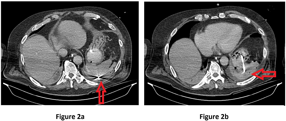 Cureus Delayed Adult Gastric Perforation Following Insertion Of A