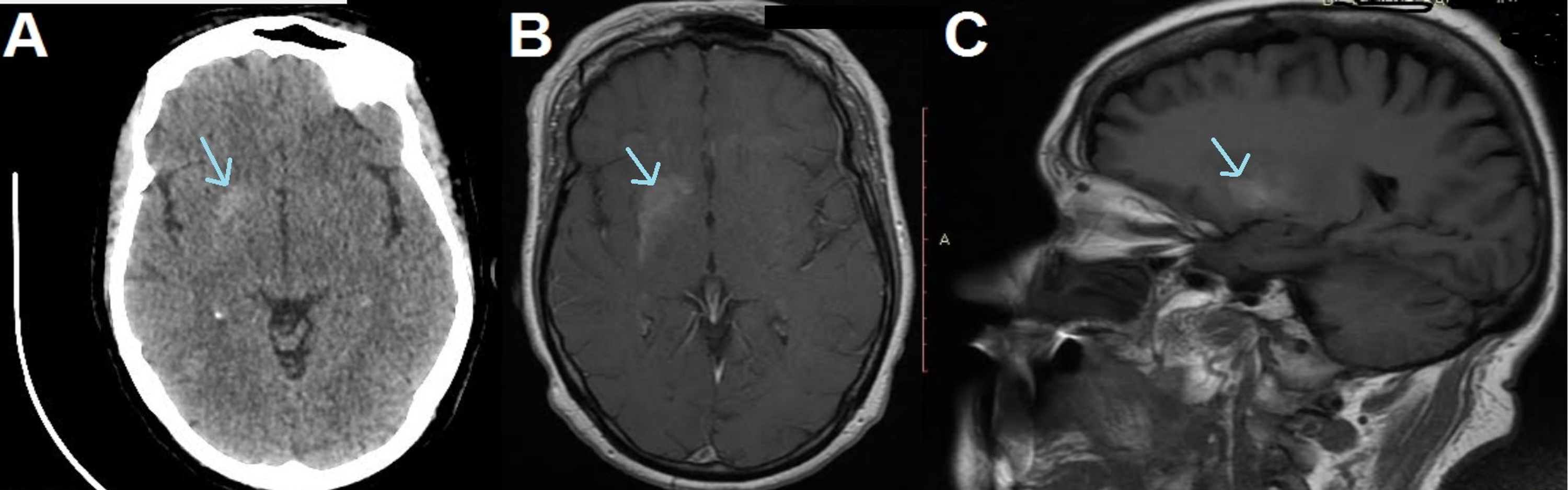 Cureus Hemichorea Hemiballismus Syndrome In Acute Non Ketotic