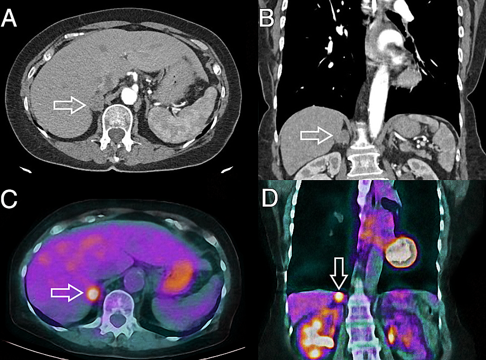 Cureus Incidental Adrenal Mass In A Patient With Surgically Treated Lung Adenocarcinoma