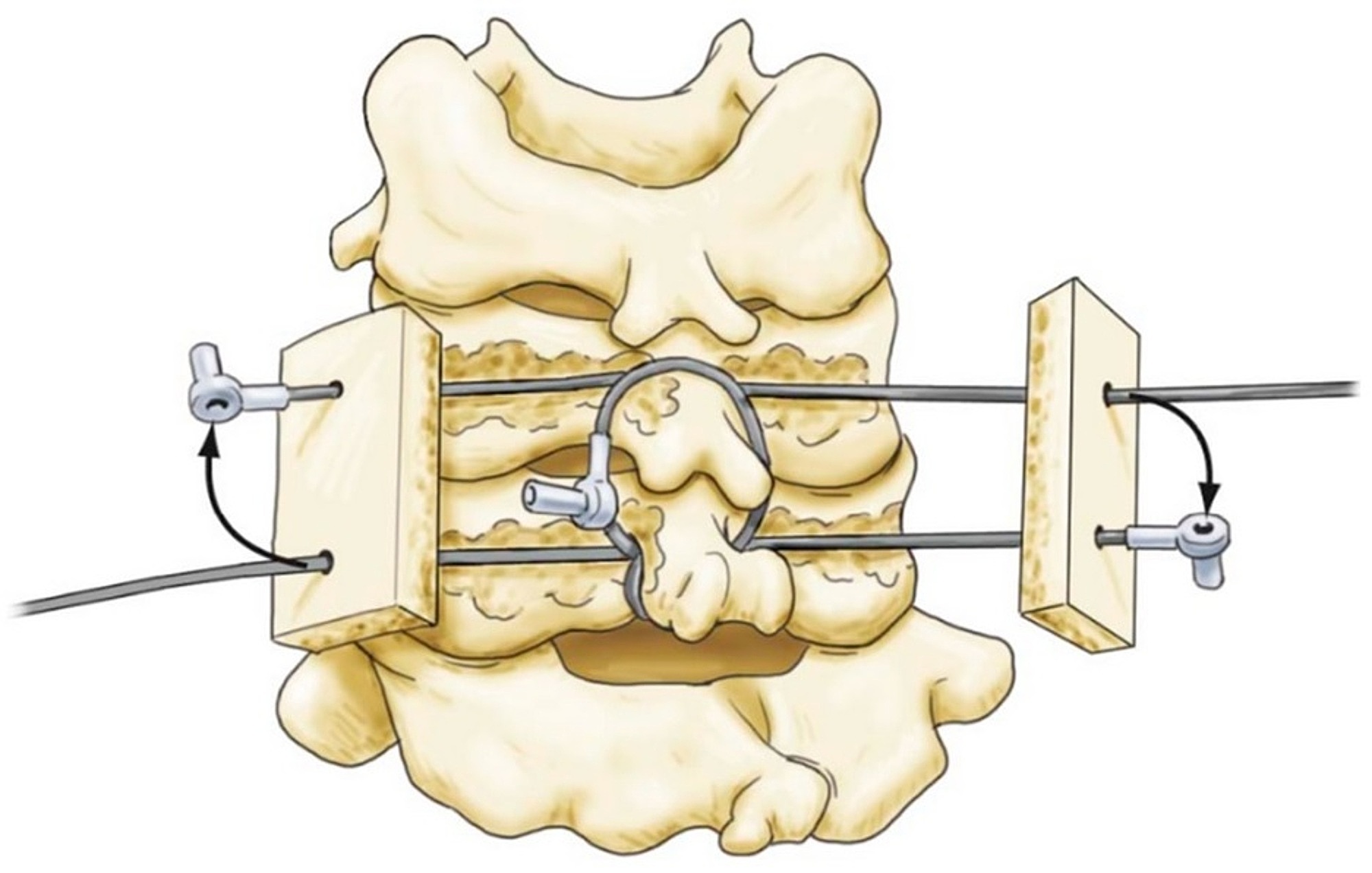 Cureus Posterior Fixation Techniques In The Subaxial Cervical Spine