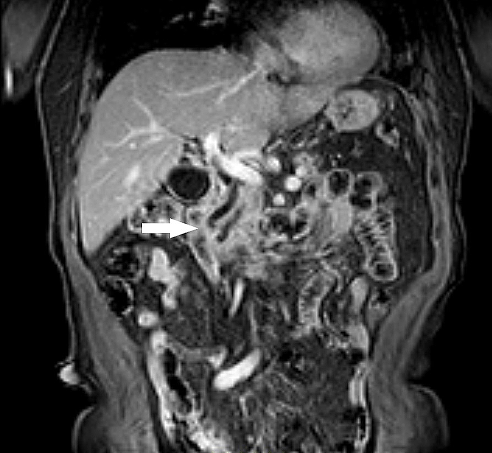 Cureus Adenomyomatous Hyperplasia Of Ampulla Of Vater And A Concomitant Renal Tumor A Case Report