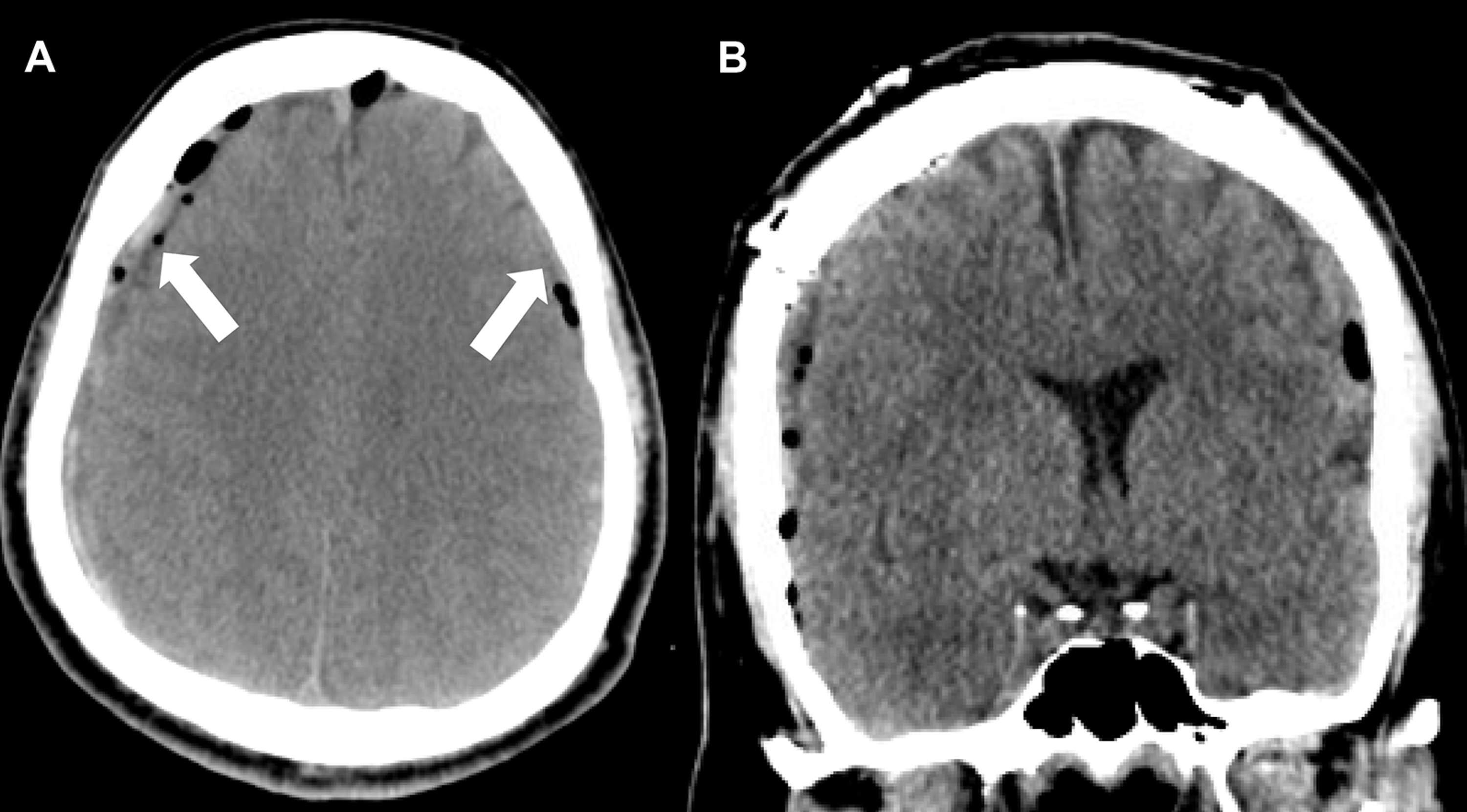 Cureus Middle Meningeal Artery Embolization As An Adjuvant Treatment For Bilateral Chronic