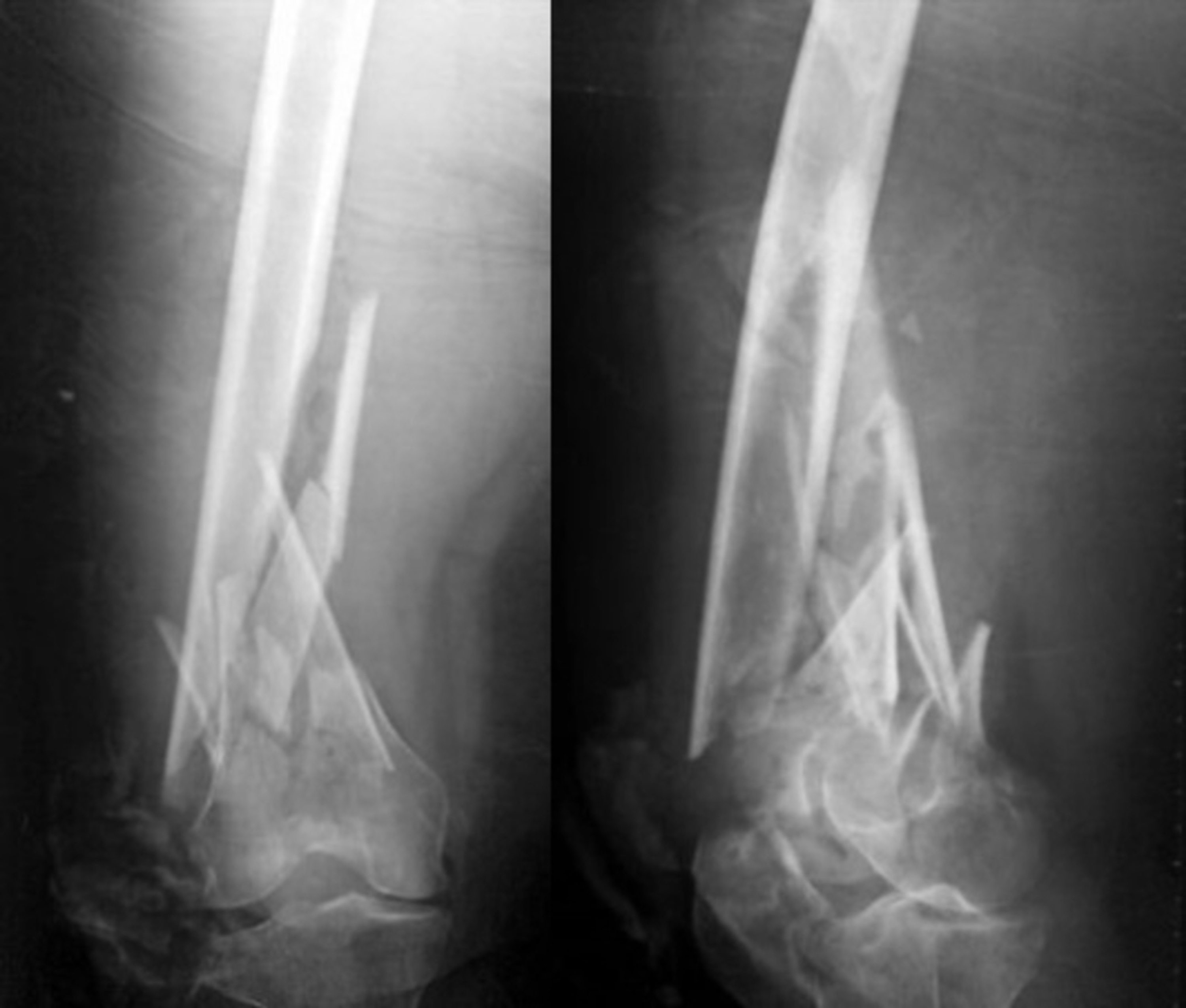 Evaluation Of The Results Of Minimally Invasive Plate Osteosynthesis