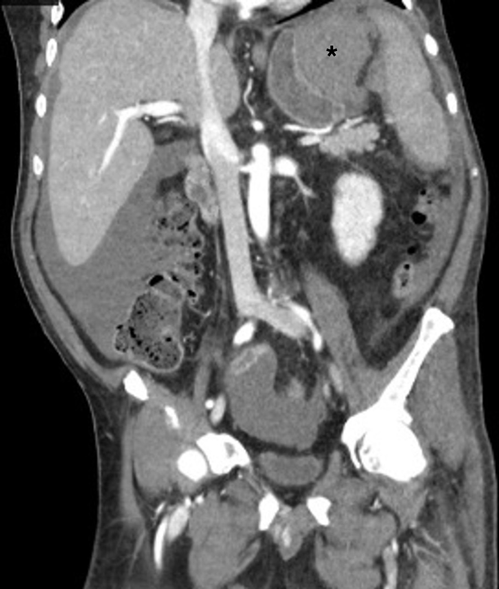 A Rare Case Of Gastric Intramural Hematoma In Recurrent Leukemia Cureus