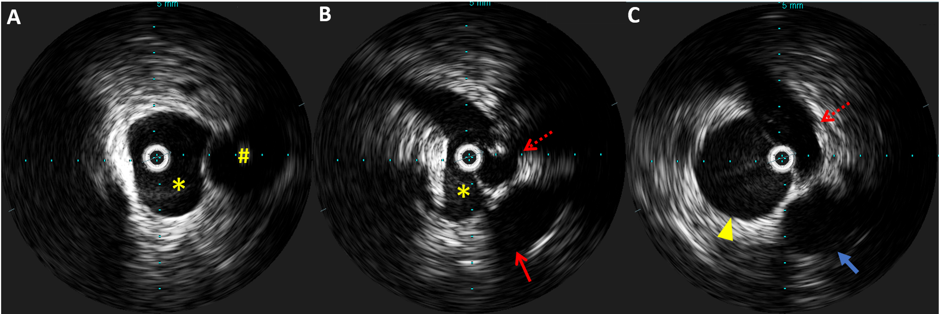 Cureus May Thurner Syndrome In An Elderly Man