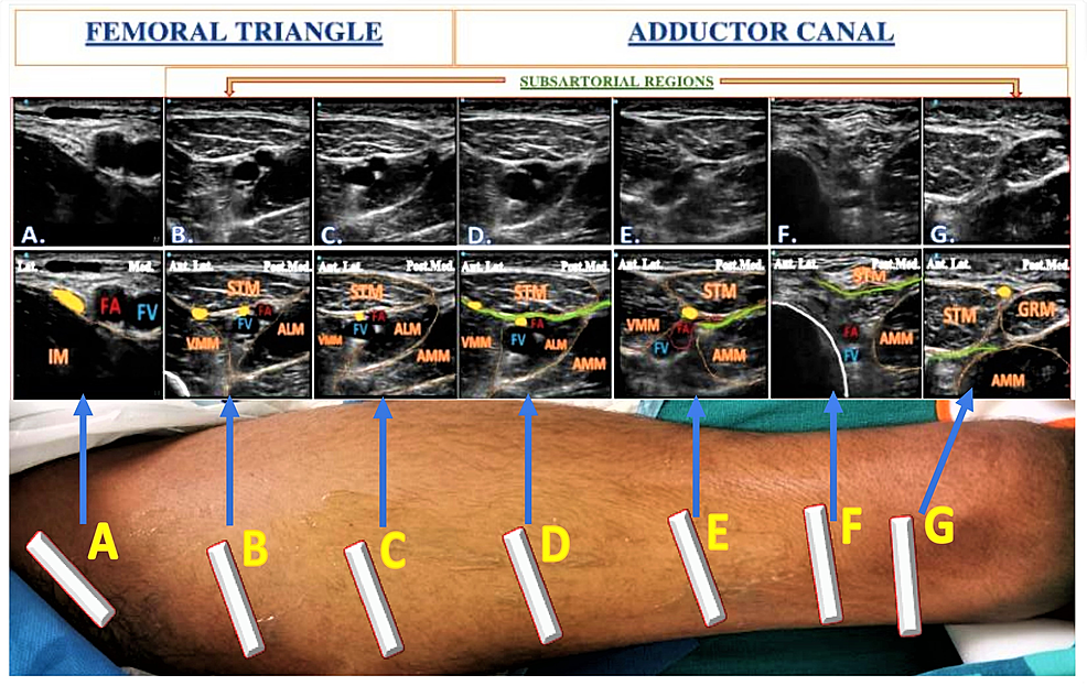 Anatomical And Technical Considerations Of The Hi Pac Hi Volume