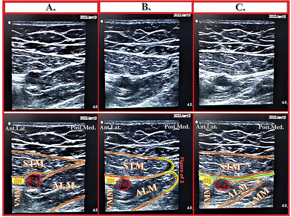 Anatomical And Technical Considerations Of The Hi PAC Hi Volume