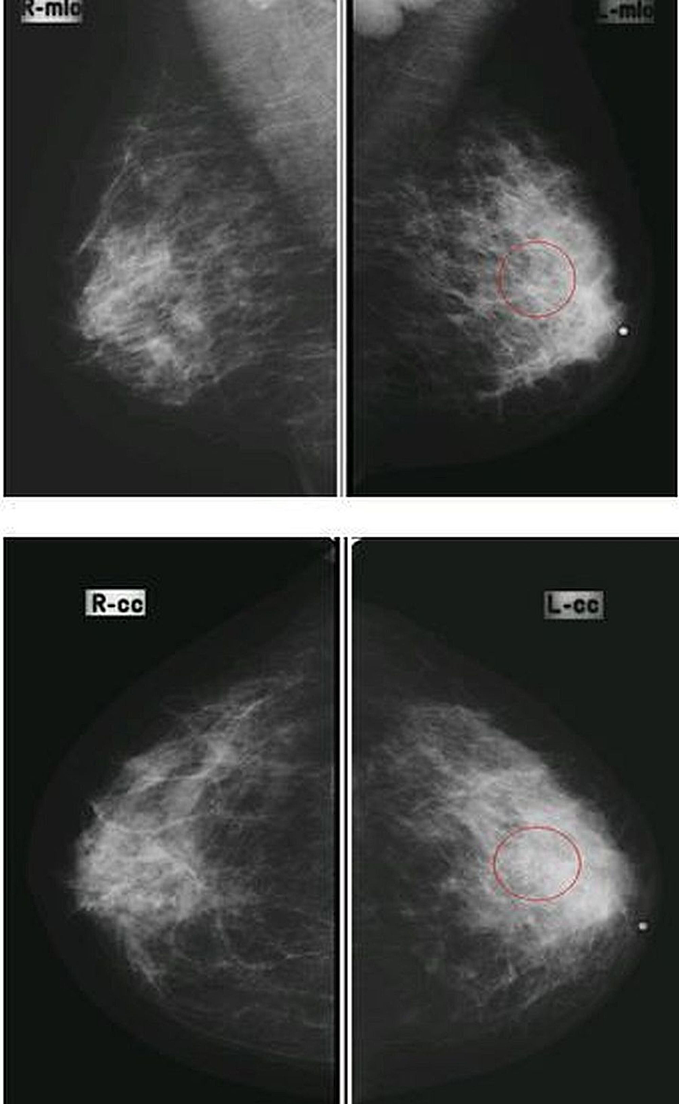 diagnostic accuracy of digital mammography in the detection of