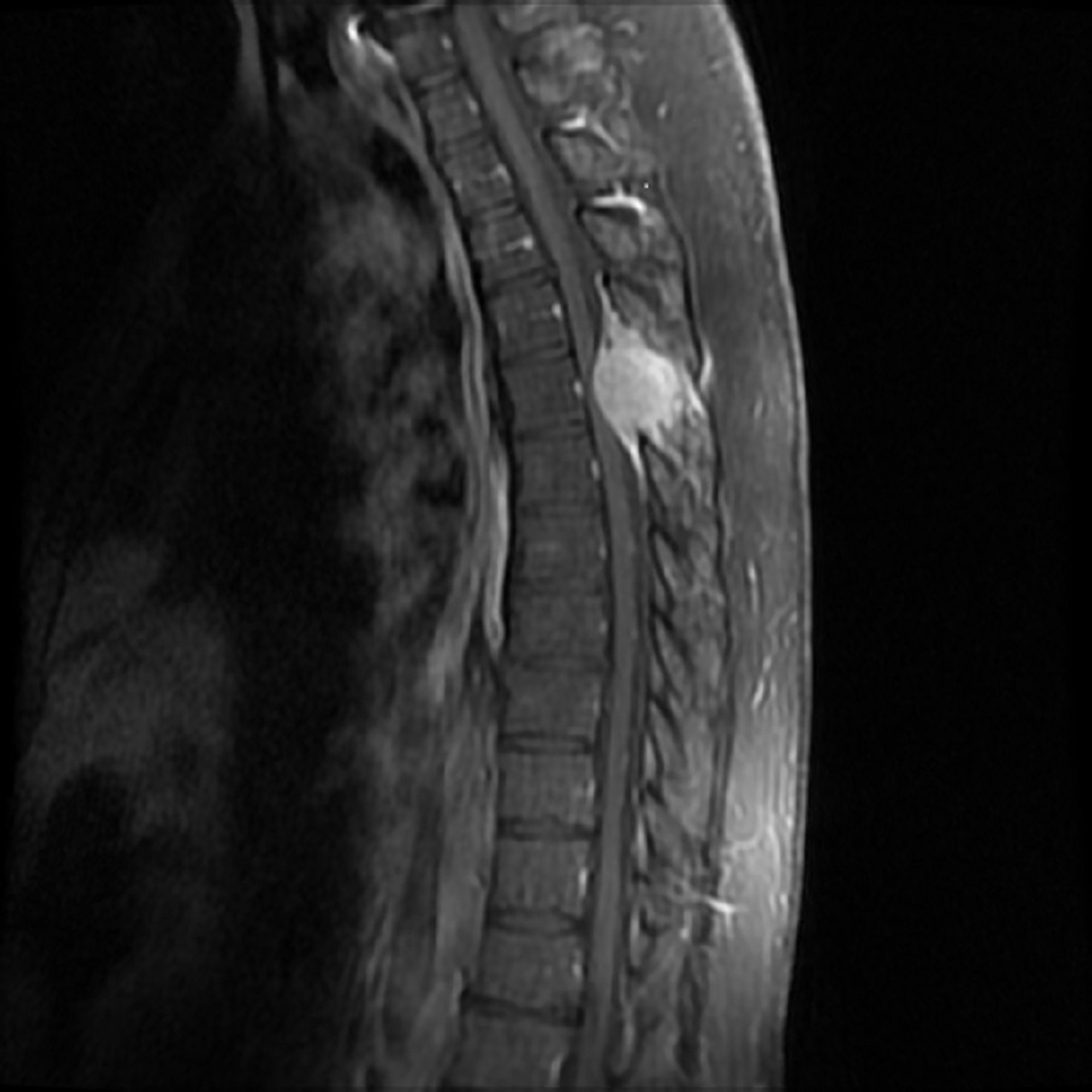 spinal cord compression