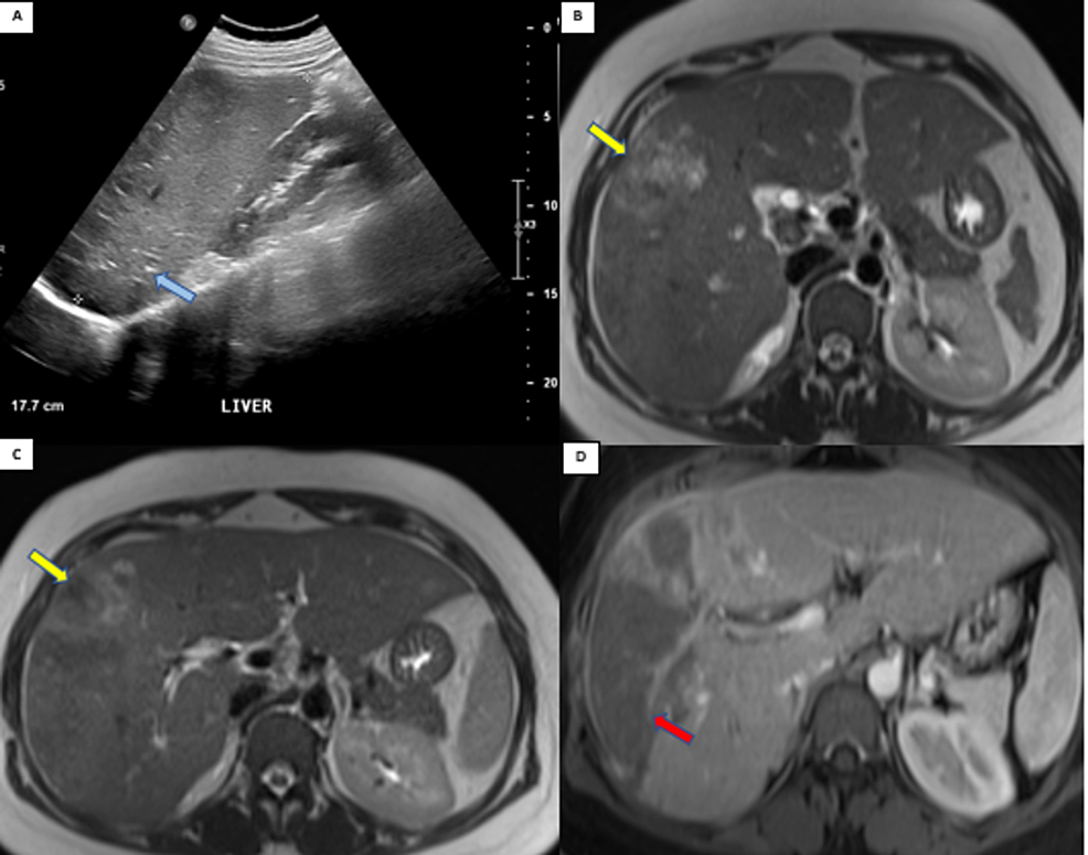 Primary Hepatic Epithelioid Hemangioendothelioma Masquerading As A