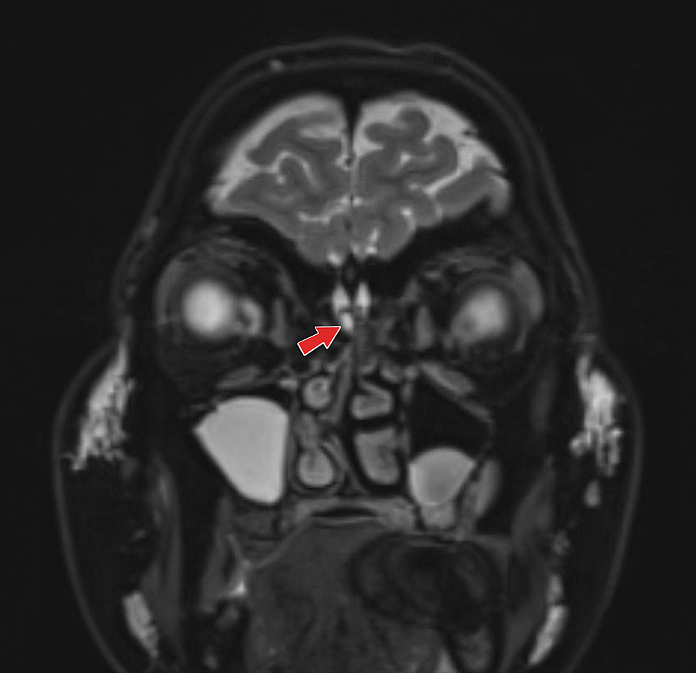 Cureus Spontaneous Cerebro Spinal Fluid Rhinorrhoea Caused By