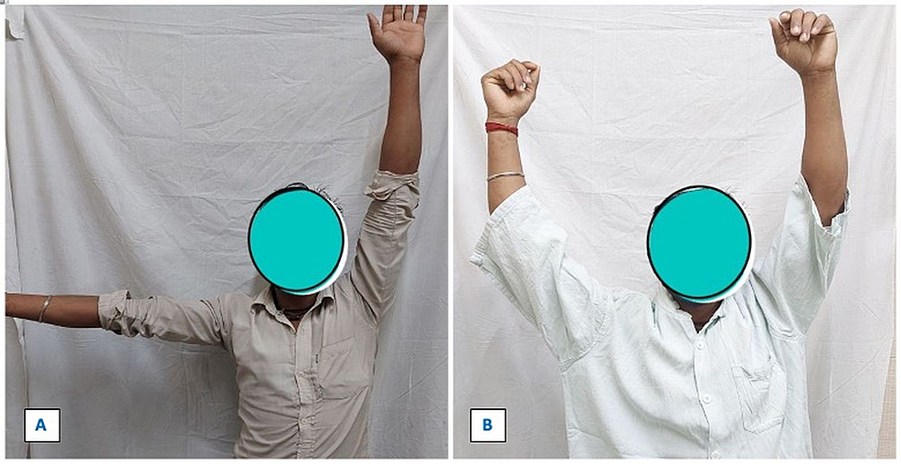 Cureus Comparative Analysis Of Clavicular Hook Plate Versus Distal