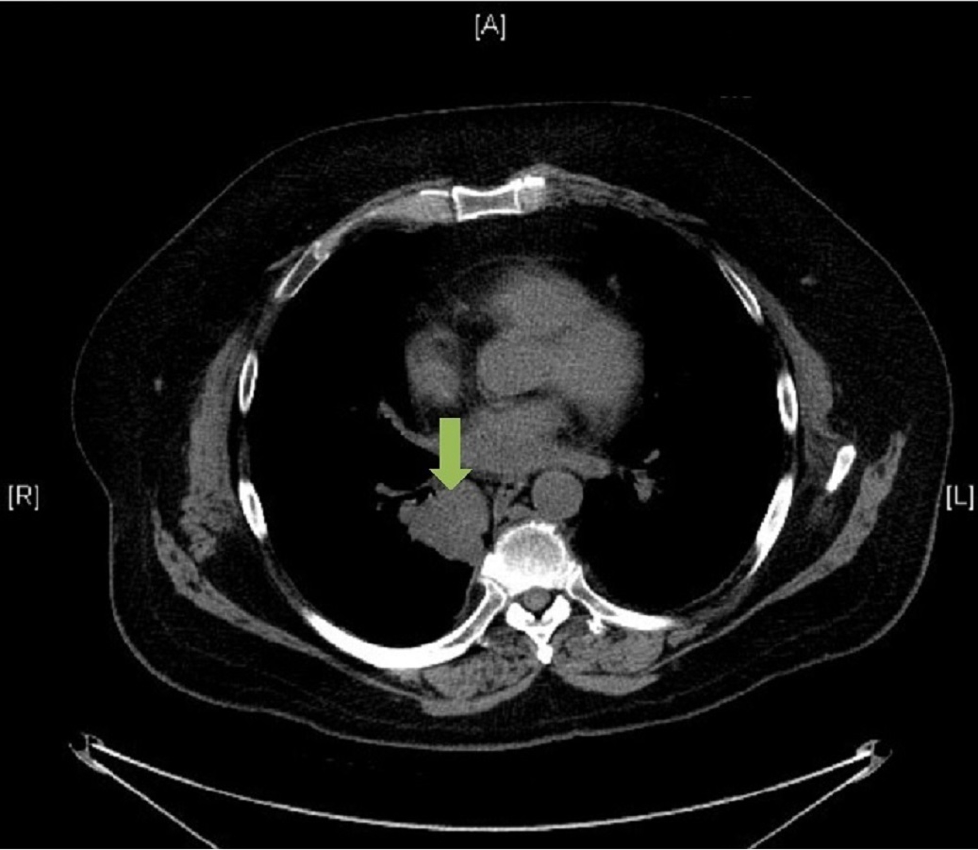 Image Result For Synchronous Lung Cancer Image Result For Synchronous Lung Cancer