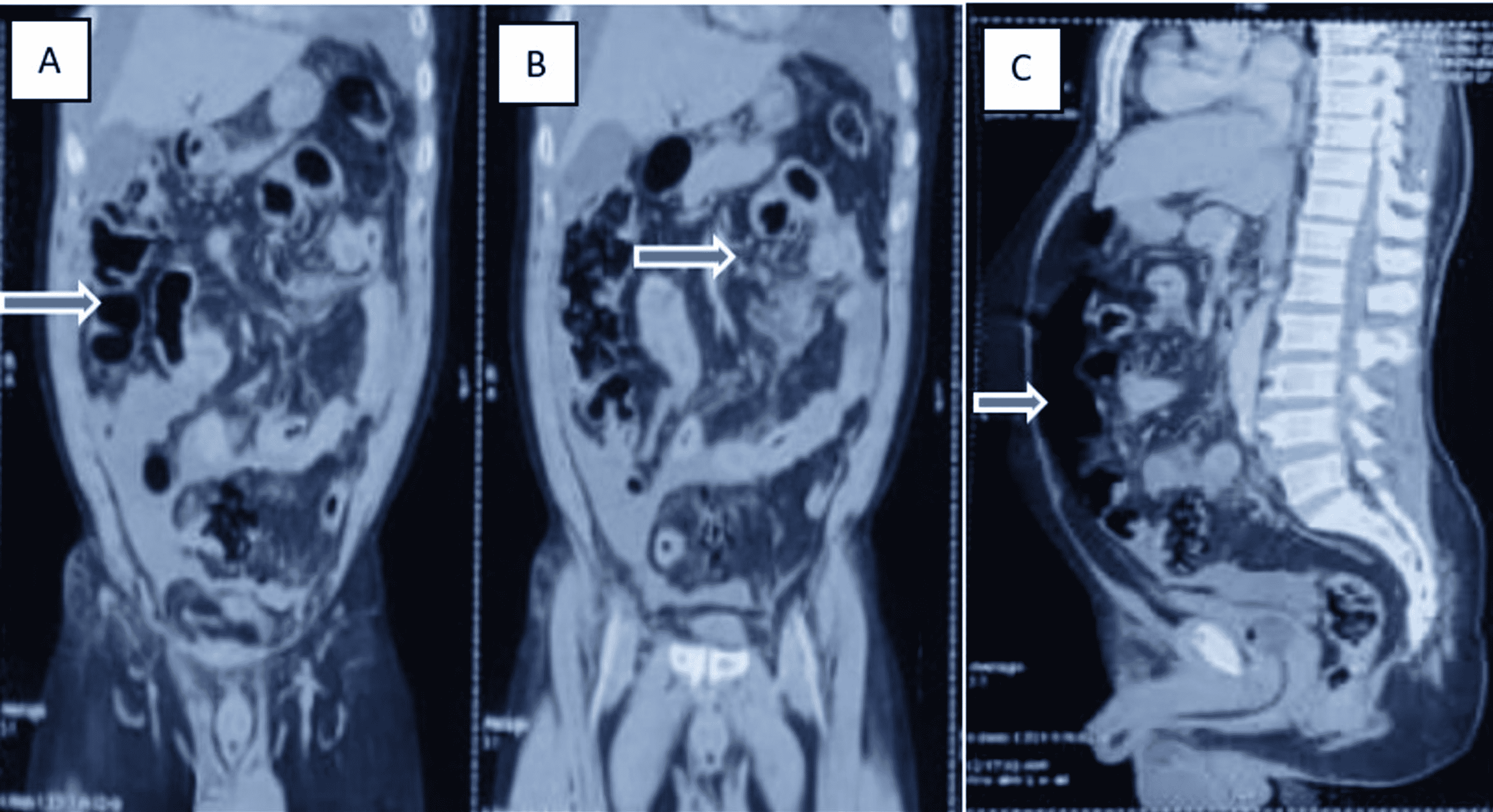 Cureus Isolated Sigmoid Colon Perforation In The Setting Of Blunt