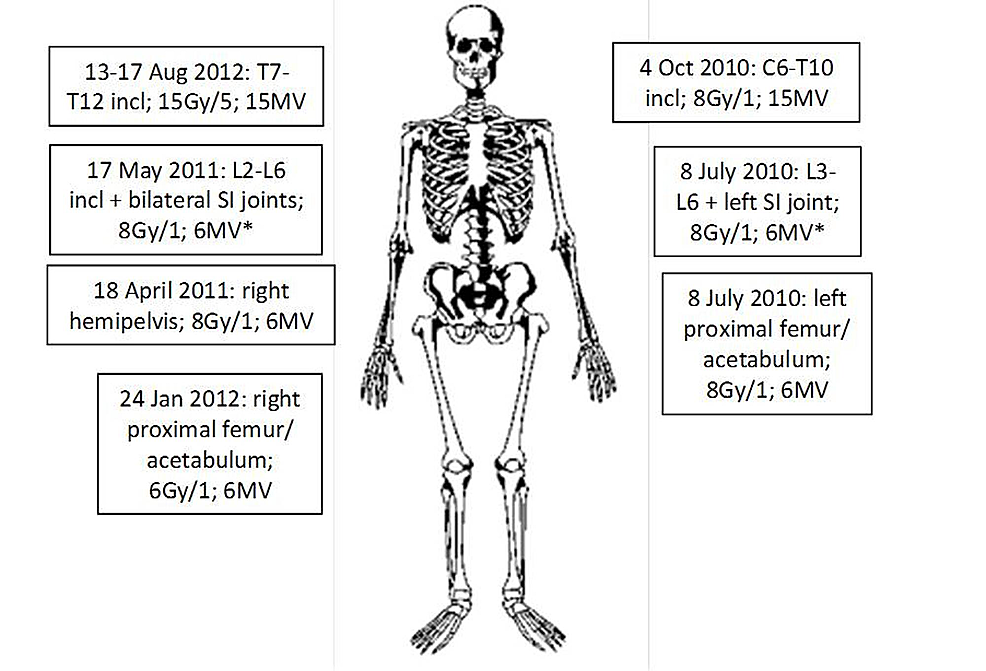 Most cancers Prostate Radiotherapy Dose