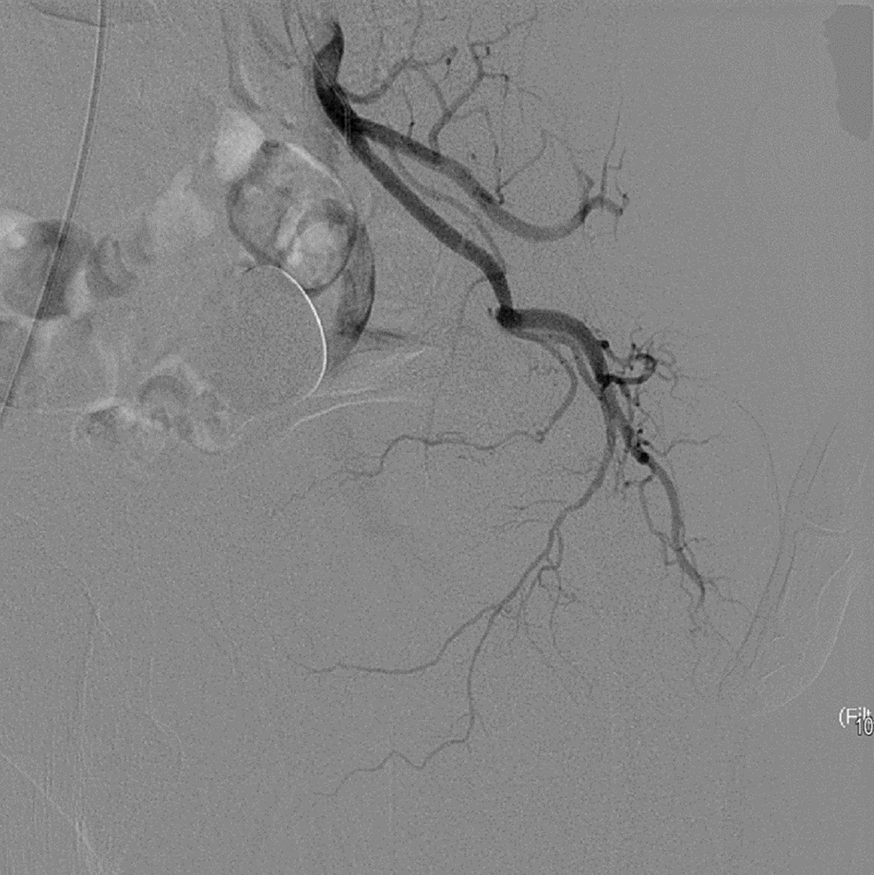 Prostatic Artery Embolization For The Treatment Of Benign Prostate