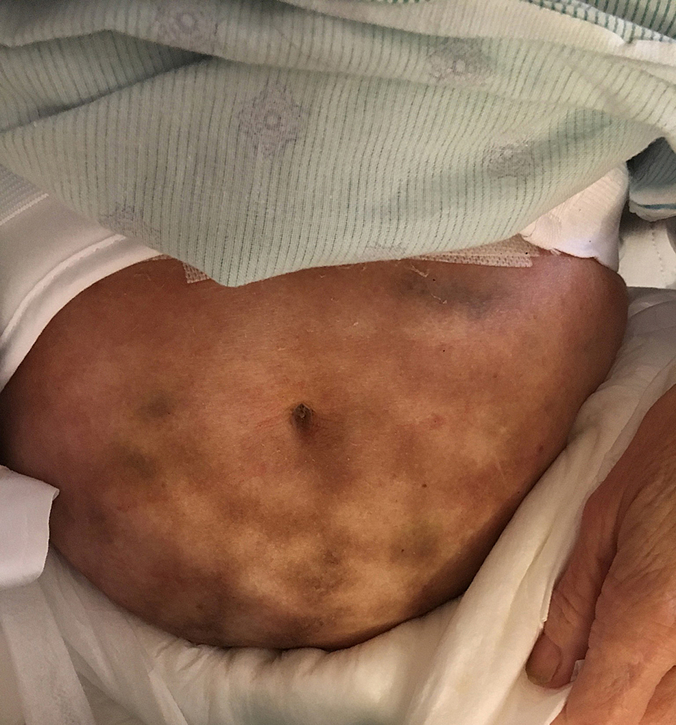 Cureus Erythema Ab Igne From Heating Pad Use A Report Of Three