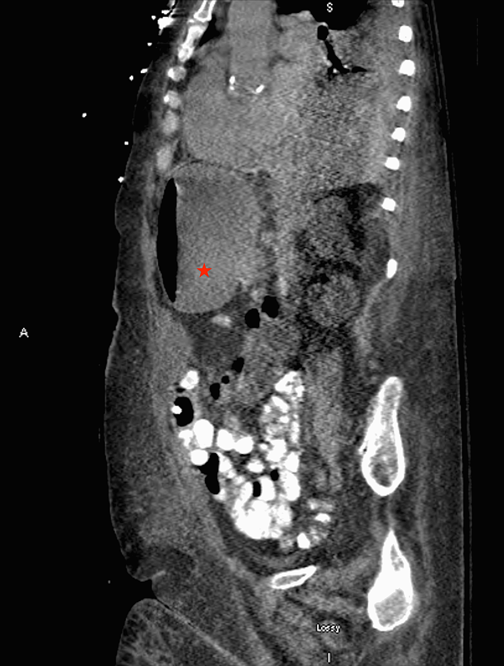 Cureus Jejunal Ileal Diverticulosis Induced Witzel Tube Failure A