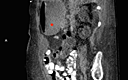 Jejunal Ileal Diverticulosis Induced Witzel Tube Failure A Rare Cause