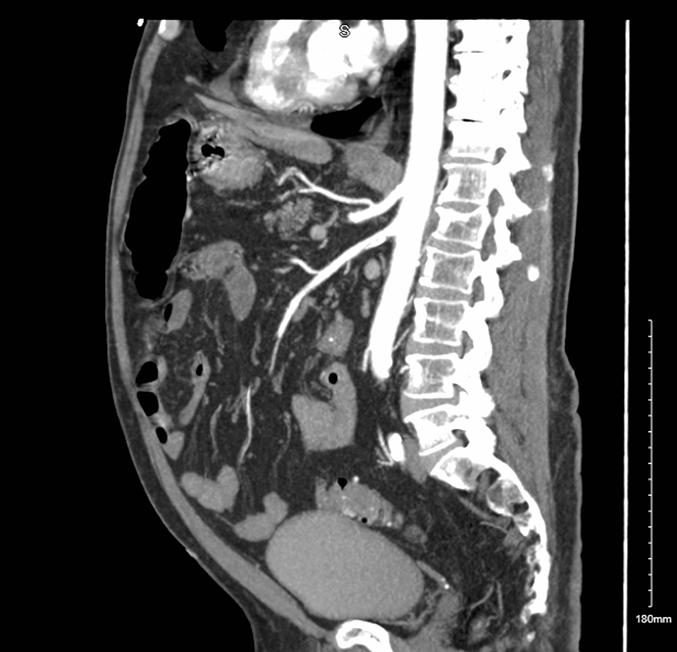 Isolated Superior Mesenteric Artery Dissection A Rare Etiology Of