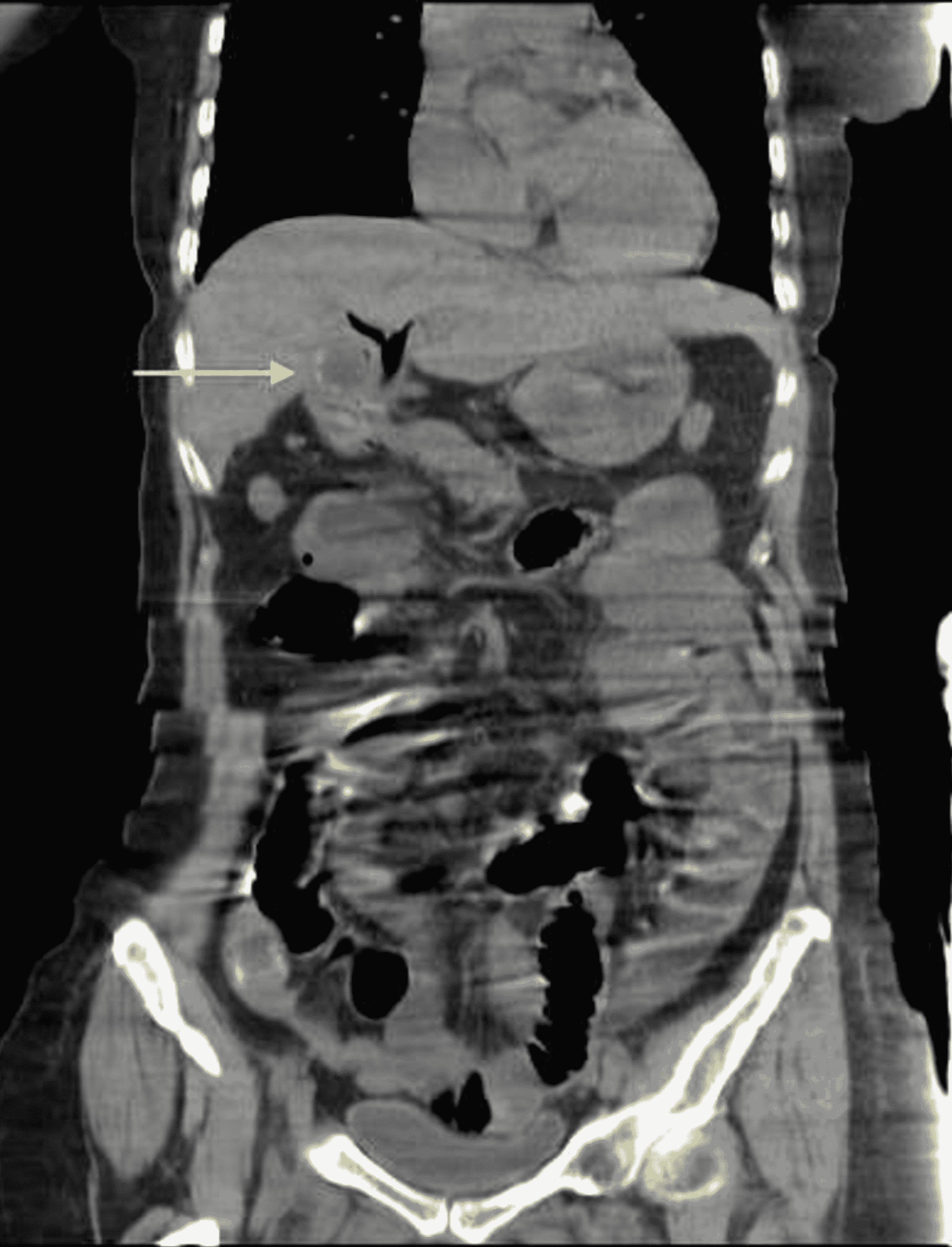 A Rare Case Of Cholecystoduodenal Fistula Complicated With Gallstone