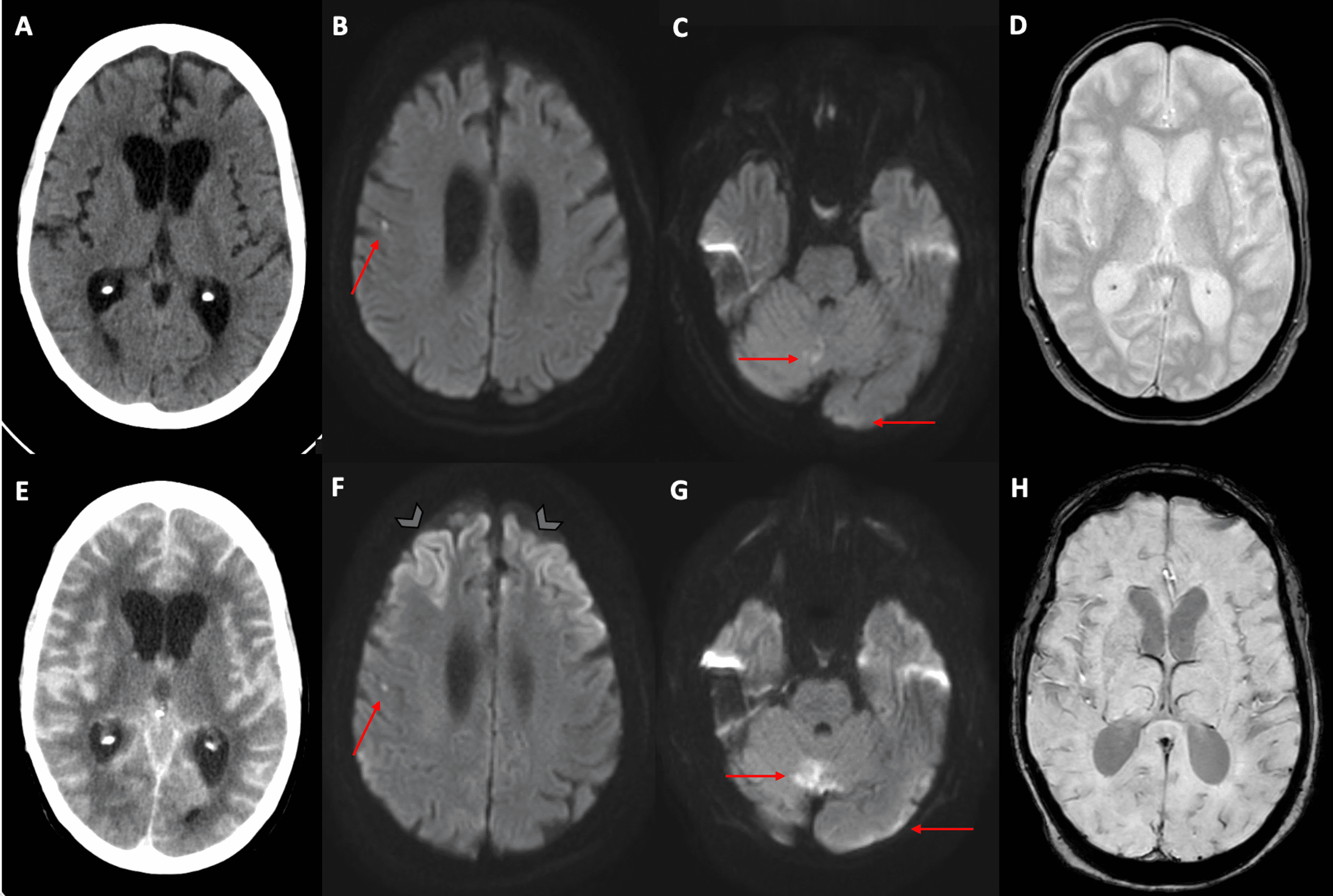 Cureus Pseudo Subarachnoid Hemorrhage Sign In Bacterial Meningitis In