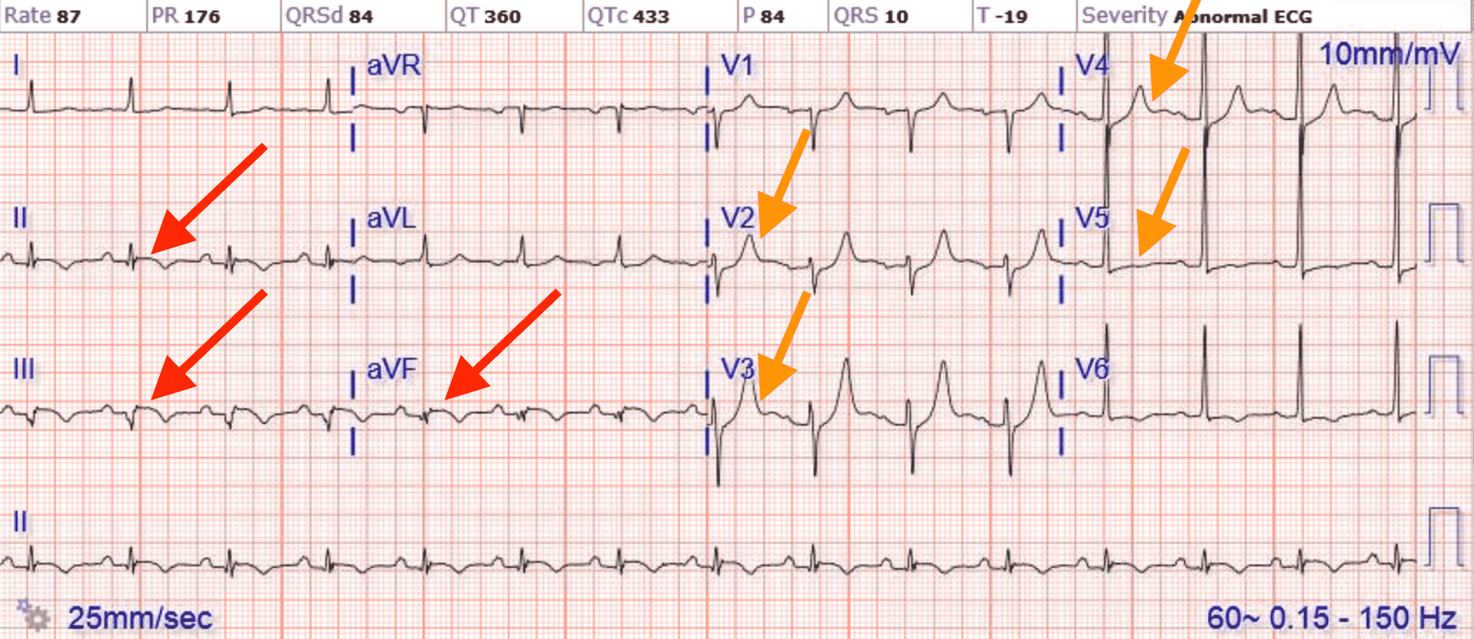 Cureus A Rare Case Of Coronary Stent Thrombosis In The Modern Era