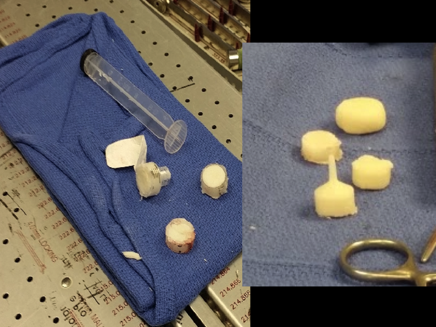 Cureus Antibiotic Spacer Arthroplasty for Revision MTP Arthrodesis A