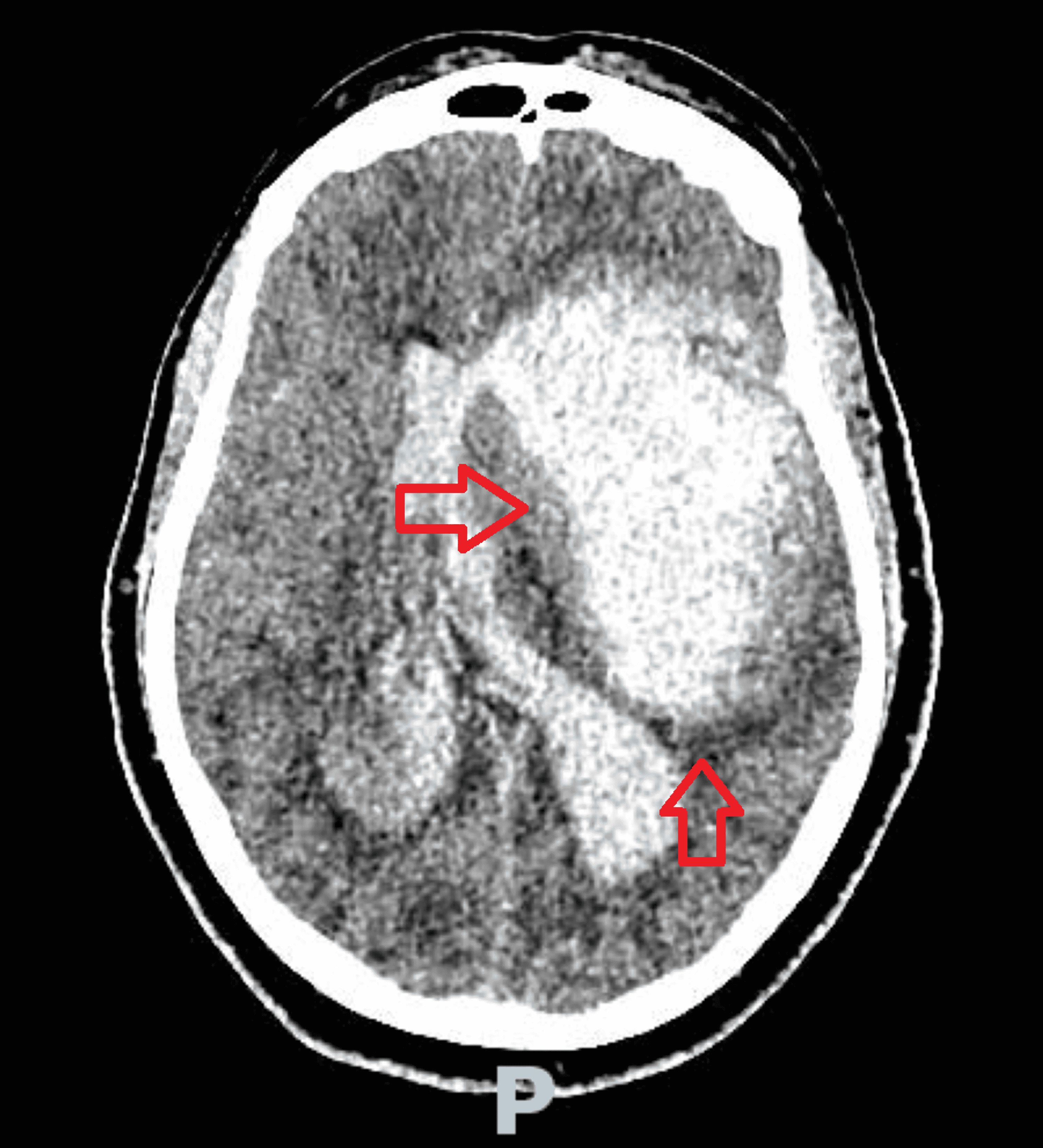 Cureus Intraparenchymal Hemorrhage A Fatal Presentation Of