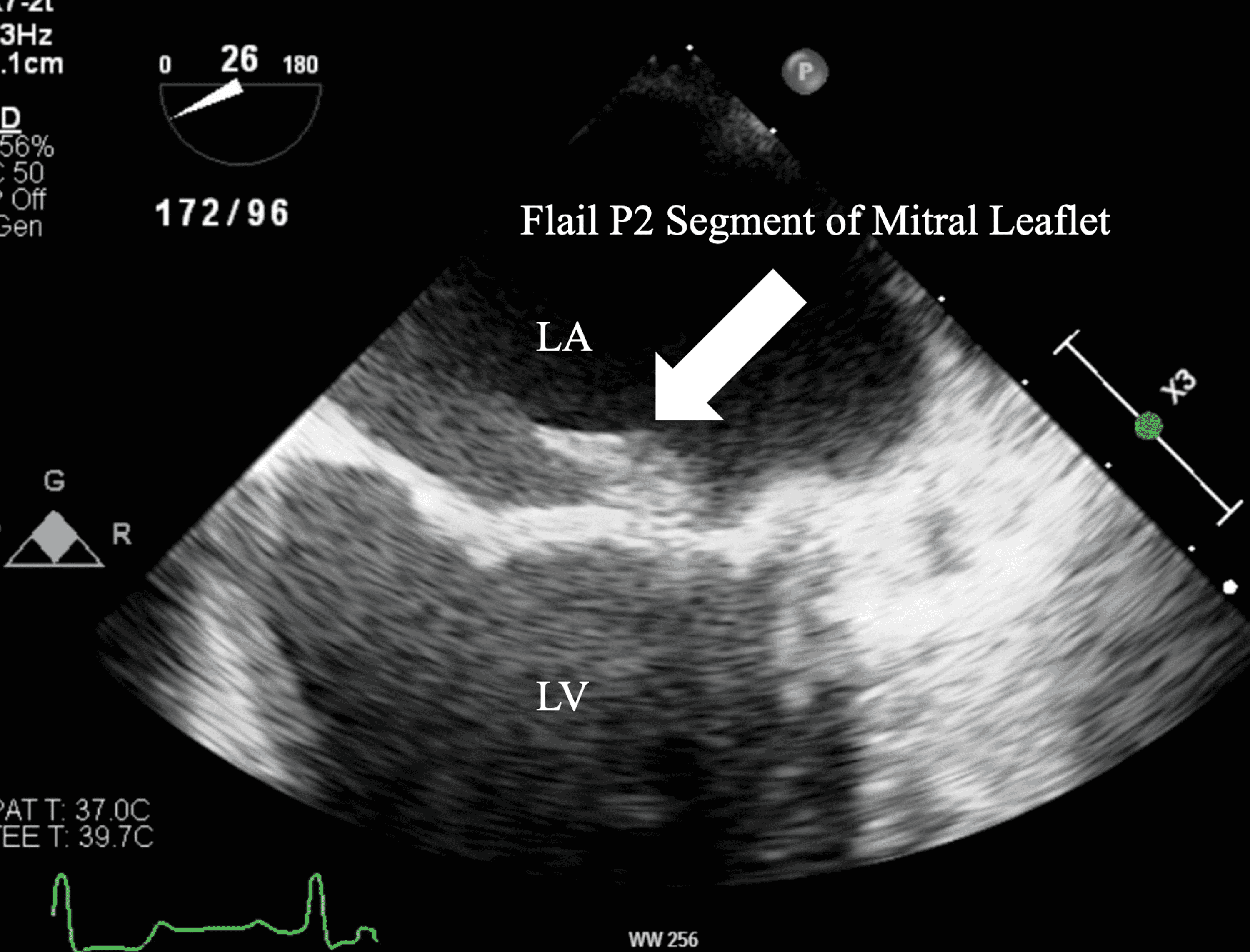 Cureus Mitral Leaflet Flail As A Late Complication Of Infective Endocarditis A Case Report