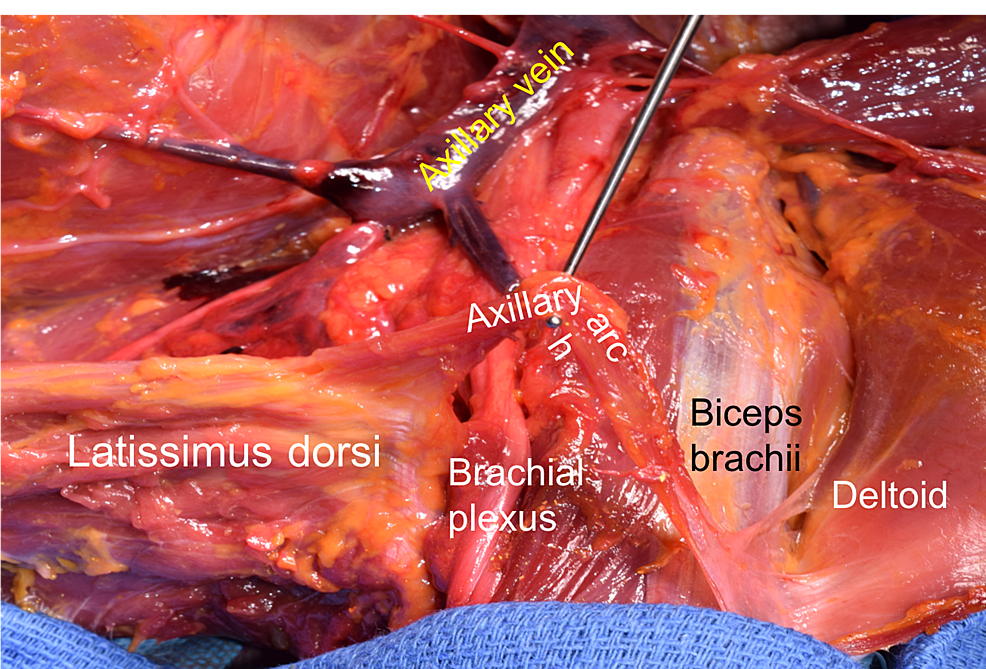 the role of the axillary arch variant in neurovascular syndrome
