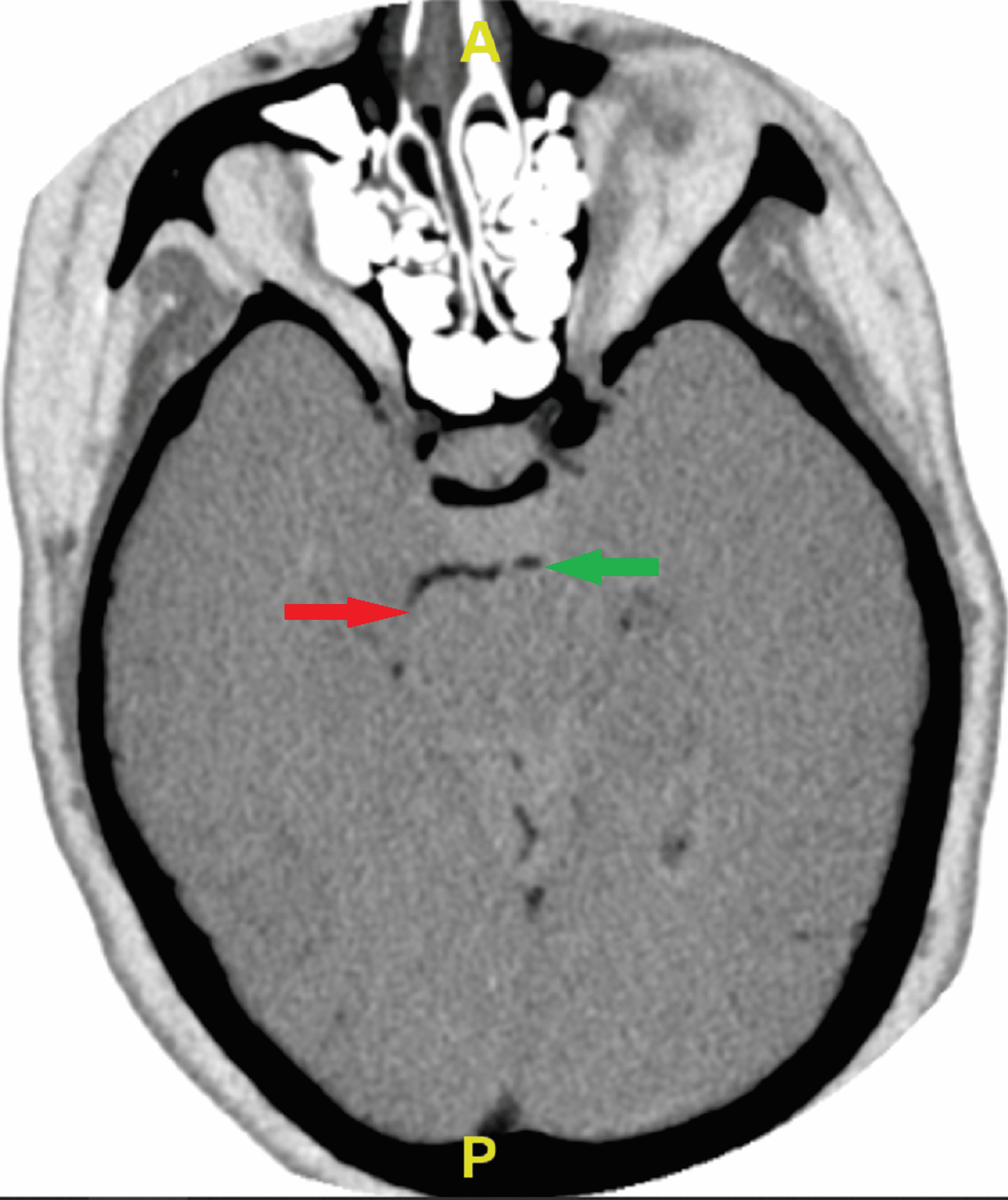 Cureus Massive Left Ventricular Thrombus Causing Bilateral Posterior