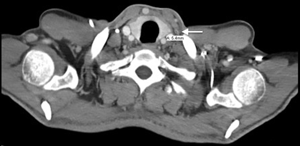Gastric Cancer Folfox