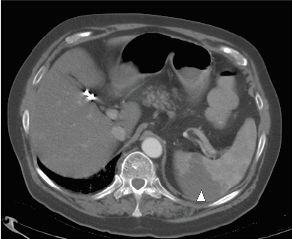 Cureus Incidental And Asymptomatic Splenic Infarction And Infrarenal Thrombus In A Covid