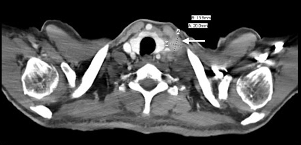 Gastric Cancer Folfox