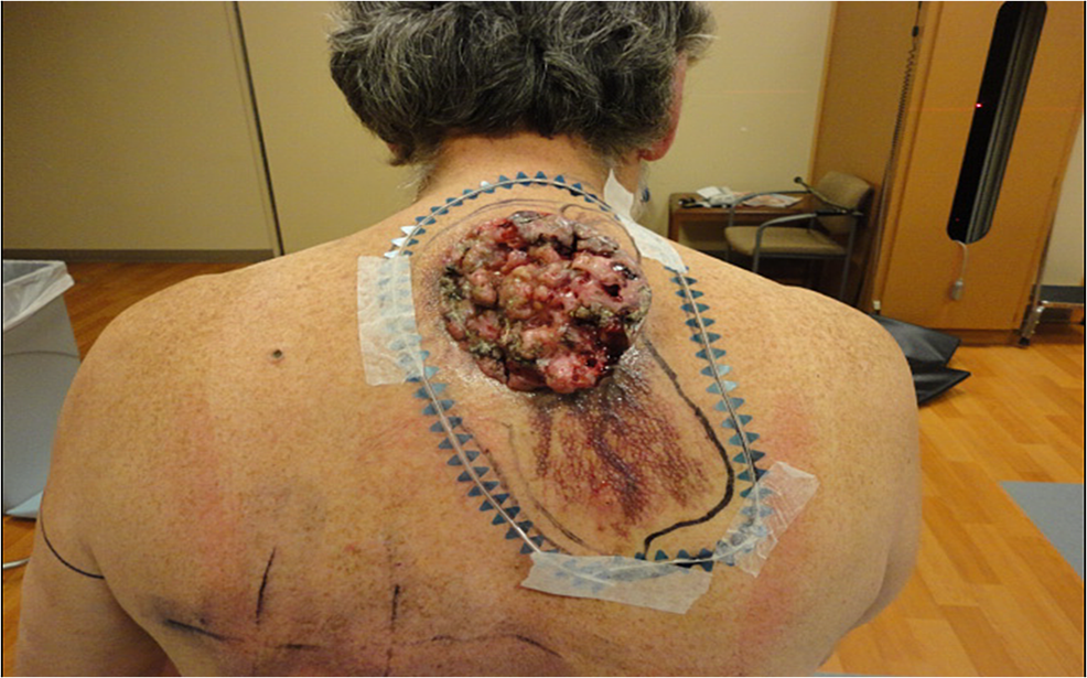 Medical Photos Basal Cell Carcinoma Squamous Carcinoma Radiation My