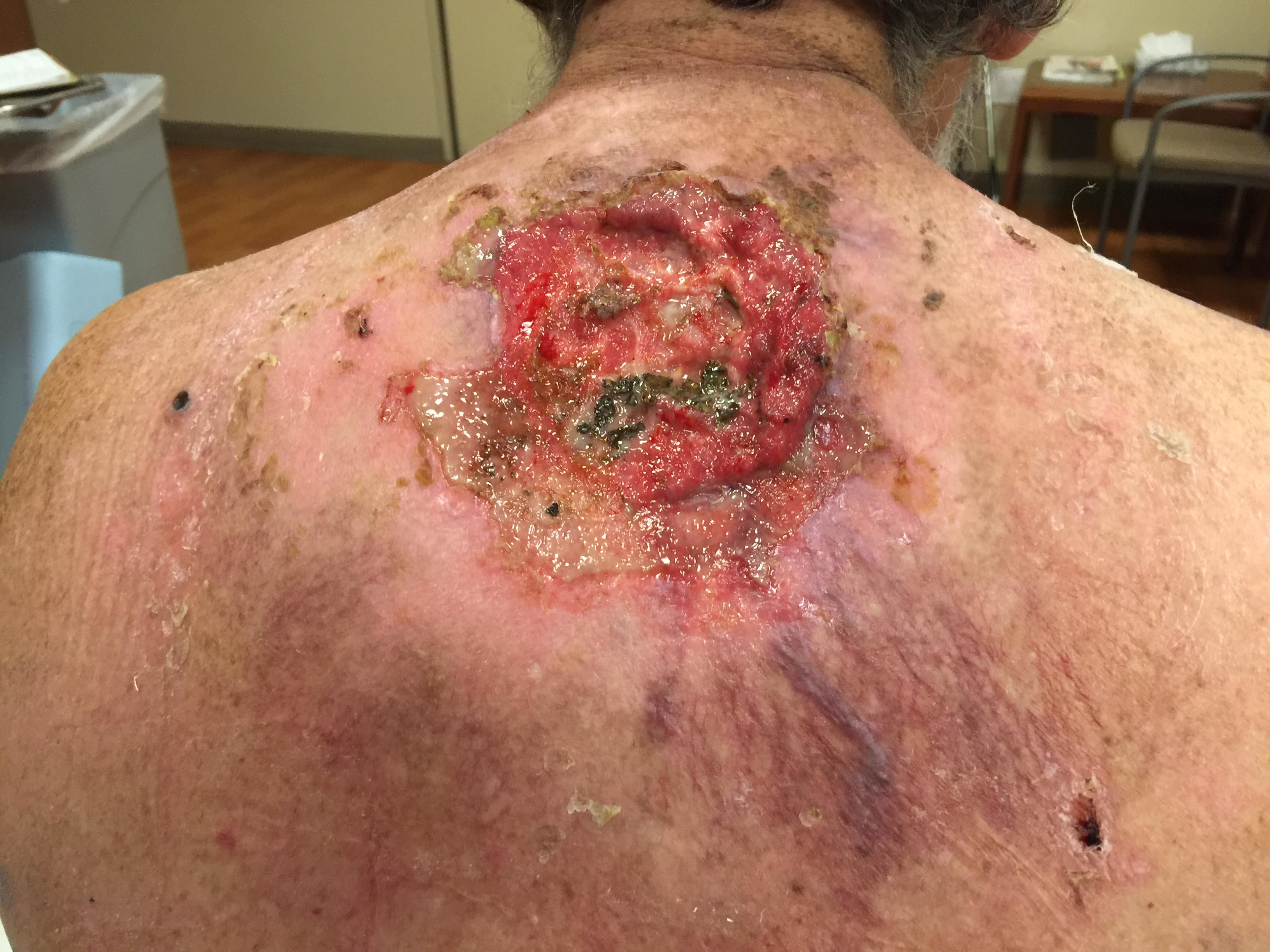 Basal Cell Carcinoma: Causes, Symptoms ... - webmd.com