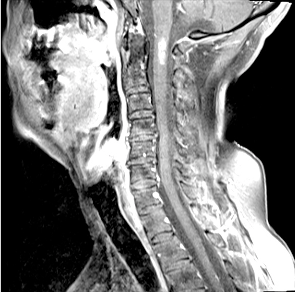 Cureus Cyberknife Radiosurgery and Concurrent Intrathecal