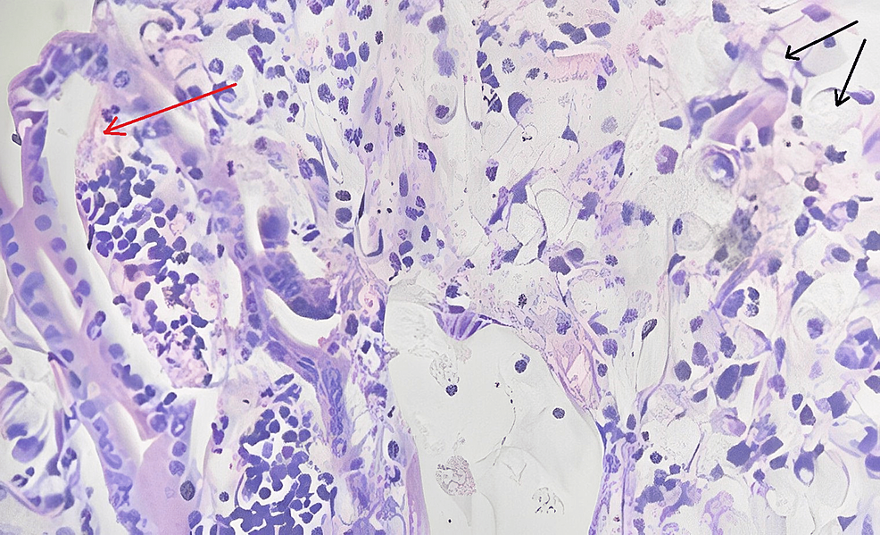 Cureus Signet Ring Cell Carcinoma At The Ampulla Of Vater A Very Rare Diagnosis