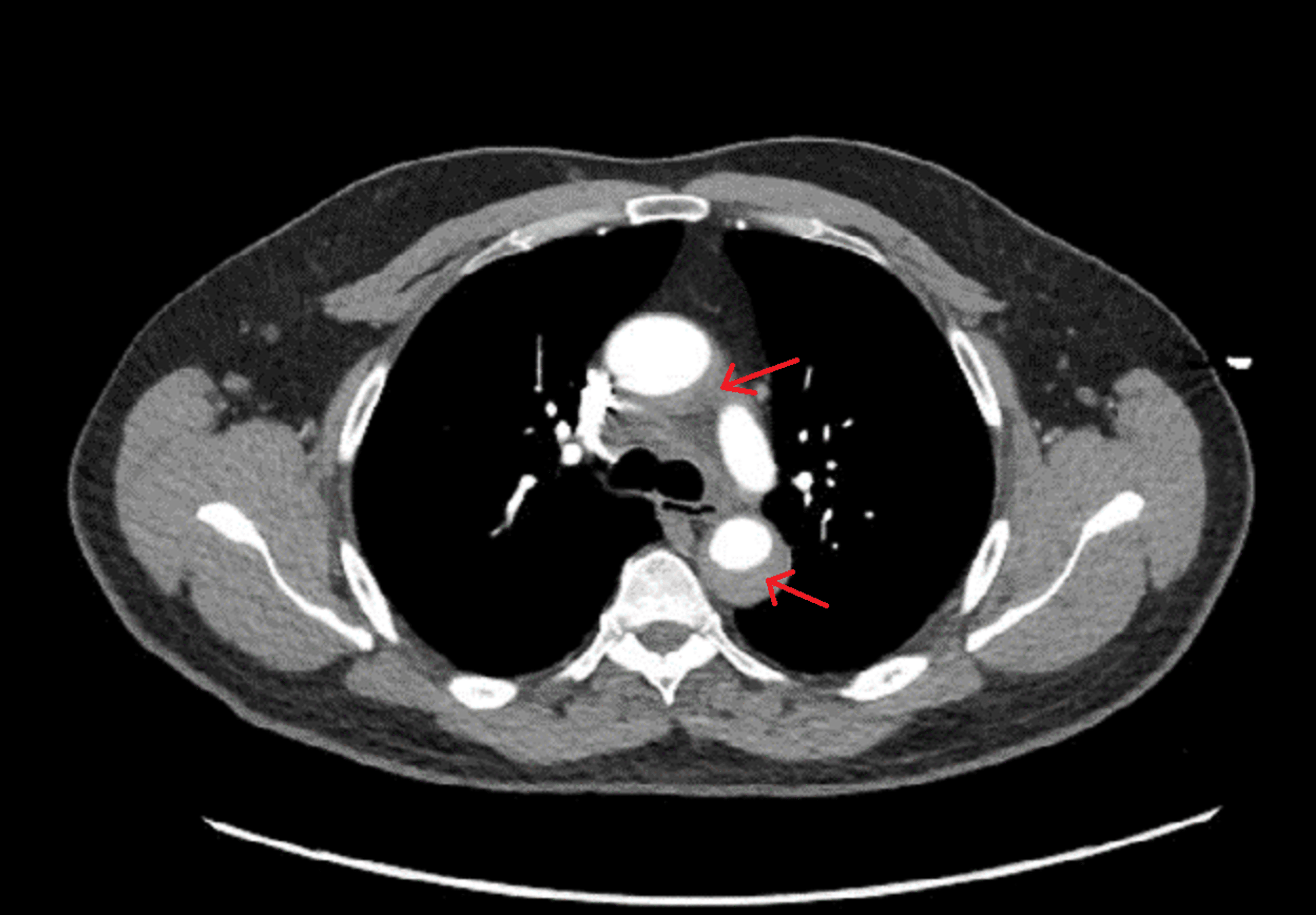 Cureus Medically Managed Type A Thoracic Intramural Hematoma And