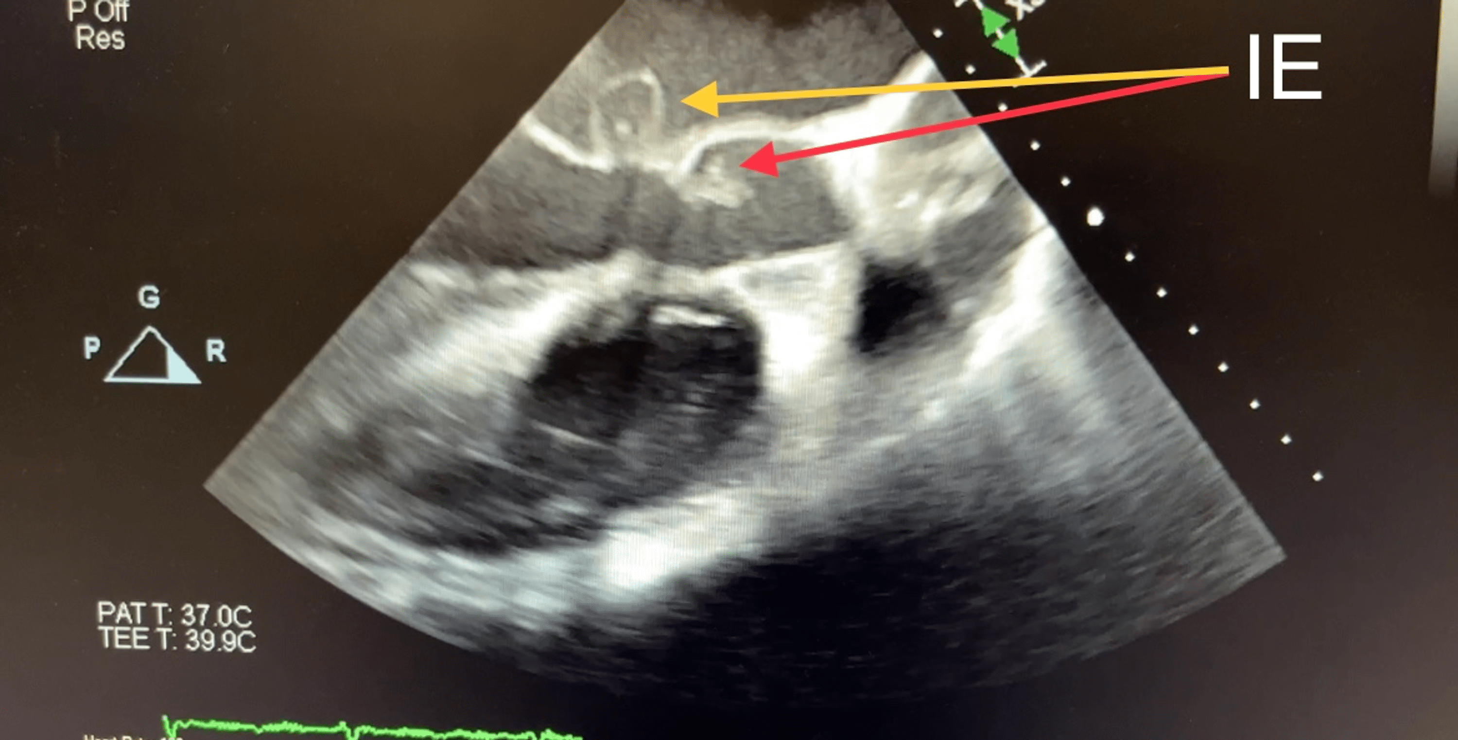 Cureus Aortic And Mitral Valve Infective Endocarditis Caused By