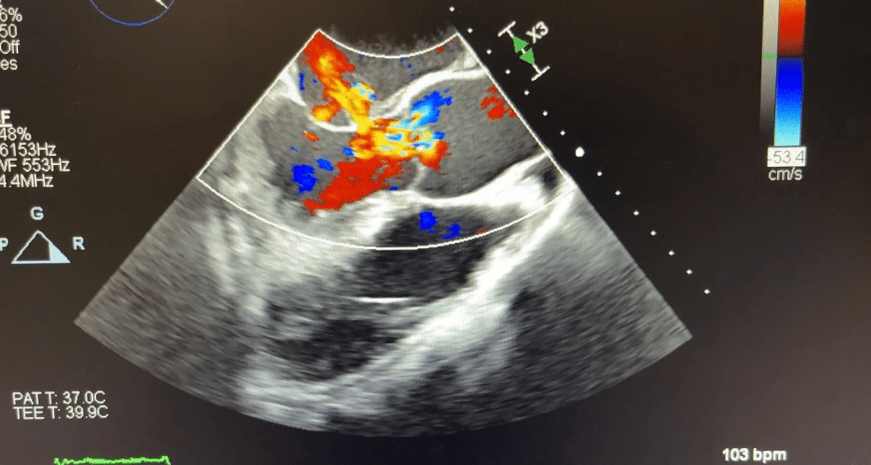 Cureus Aortic And Mitral Valve Infective Endocarditis Caused By