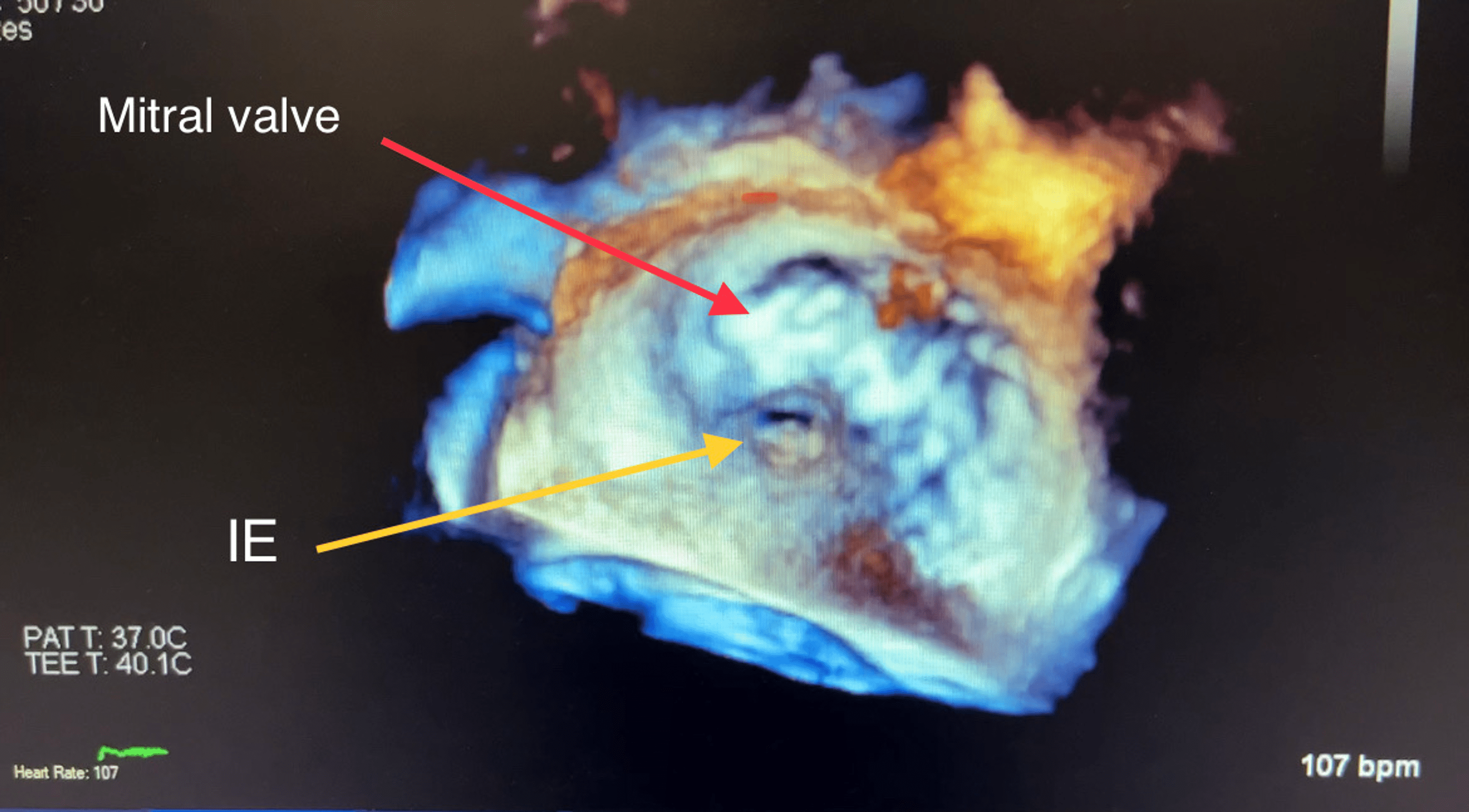 Cureus Aortic And Mitral Valve Infective Endocarditis Caused By