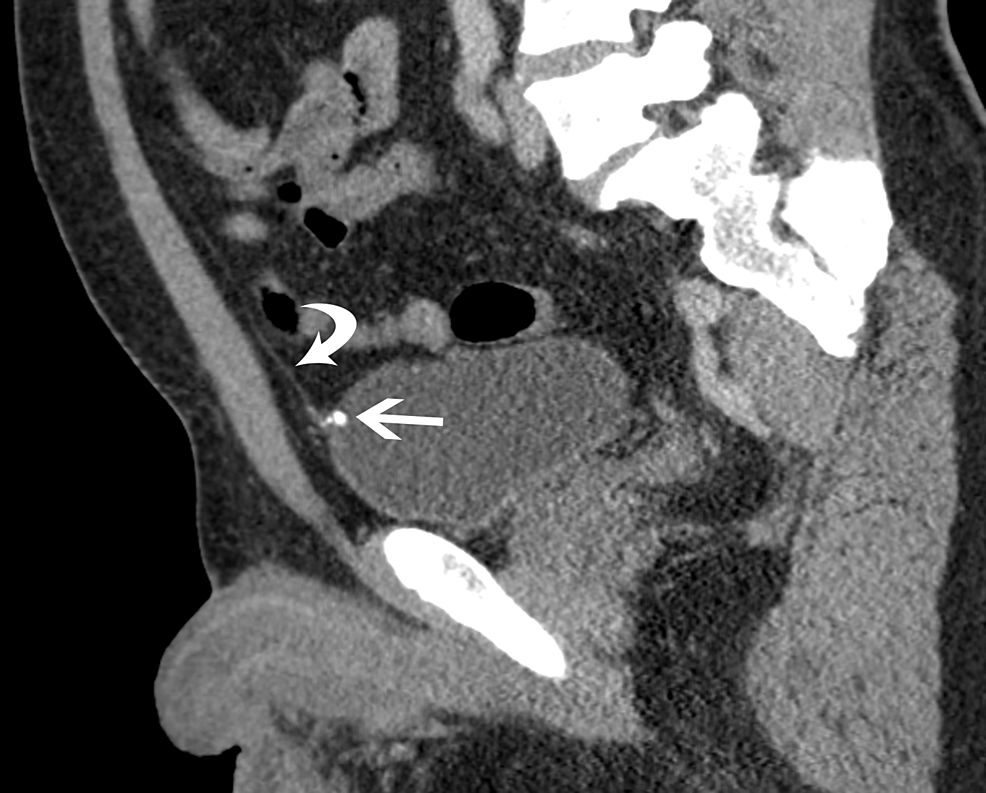 Cureus Urachal Remnant Calcification A Rare Cause Of Calcification