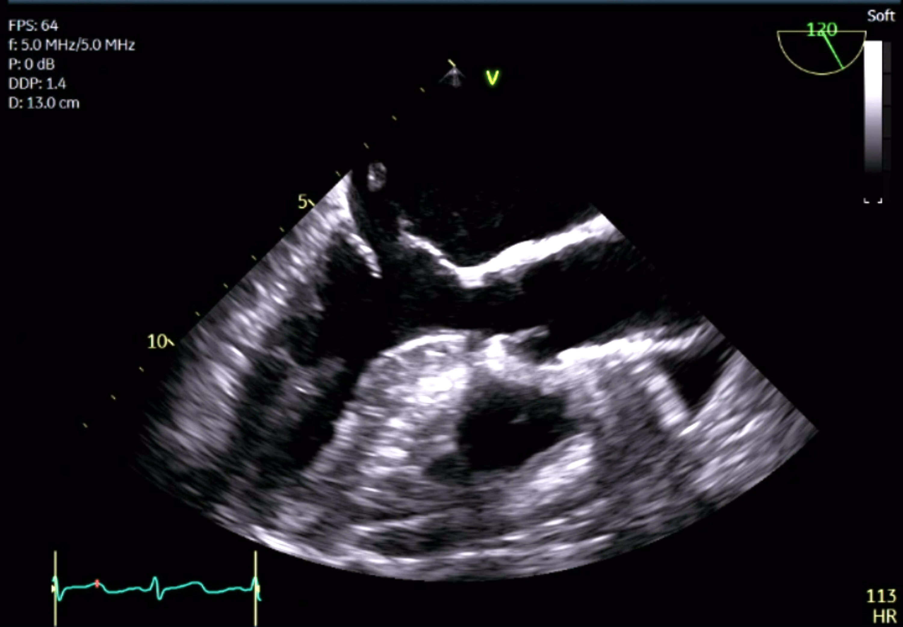 Cureus Acute Mitral Valve Regurgitation Presenting With Right Upper Lobe Opacification